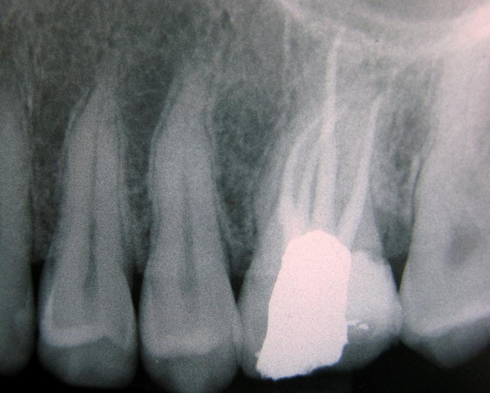 root canal image « Stephanie Gehring